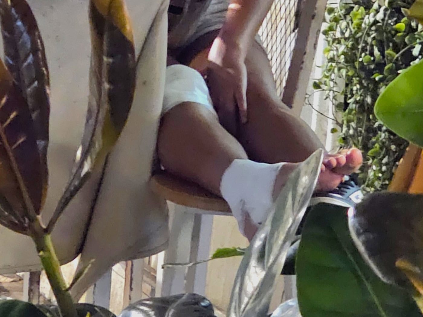 Typische Bandage am Bein einer Urlauberin in Thailand, nach einem Sturz mit einem Motorroller